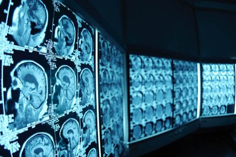 CAT scans